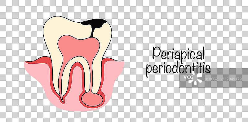 根尖周围炎图片素材