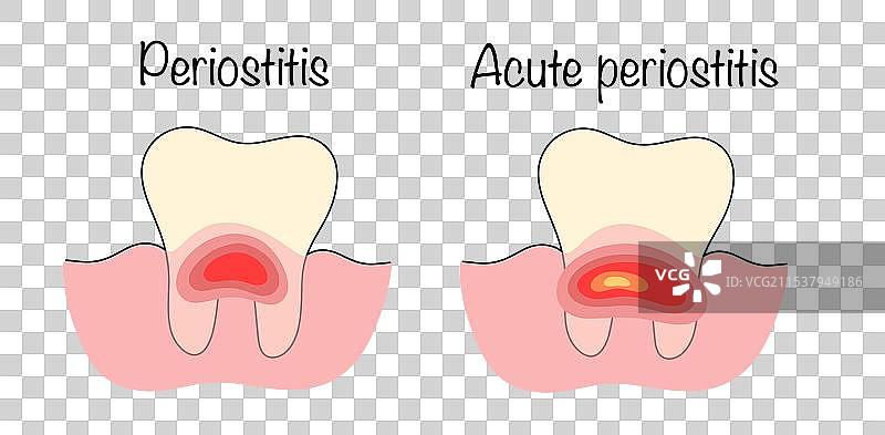 骨膜炎图片素材