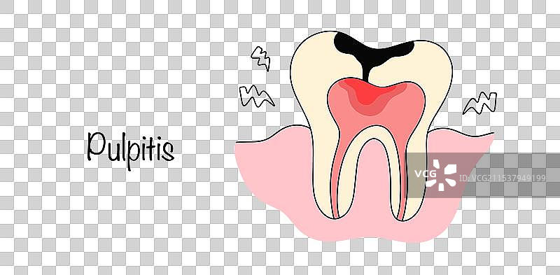 牙髓炎图片素材