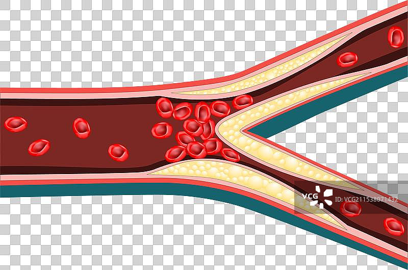 动脉粥样硬化图片素材