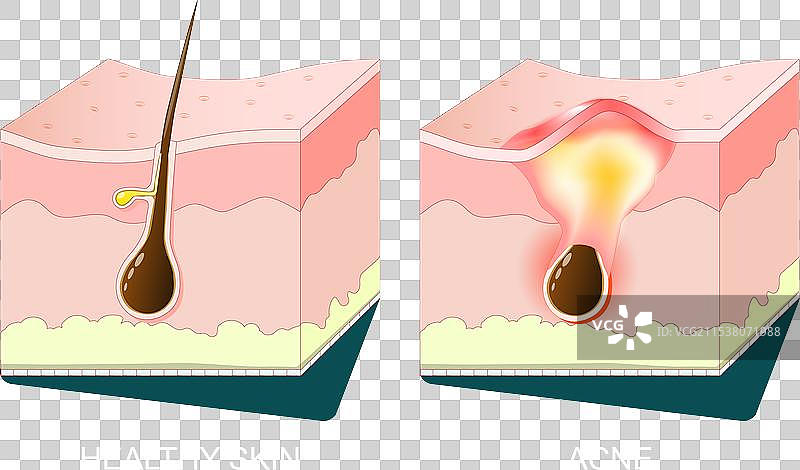 人类皮肤的痤疮横截面，带有粉刺图片素材