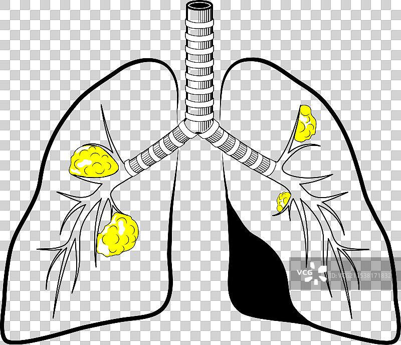 带有癌症的人的肺部黑色线条图标图片素材