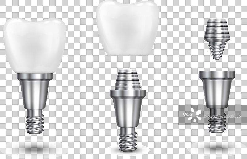 牙齿植入物图片素材