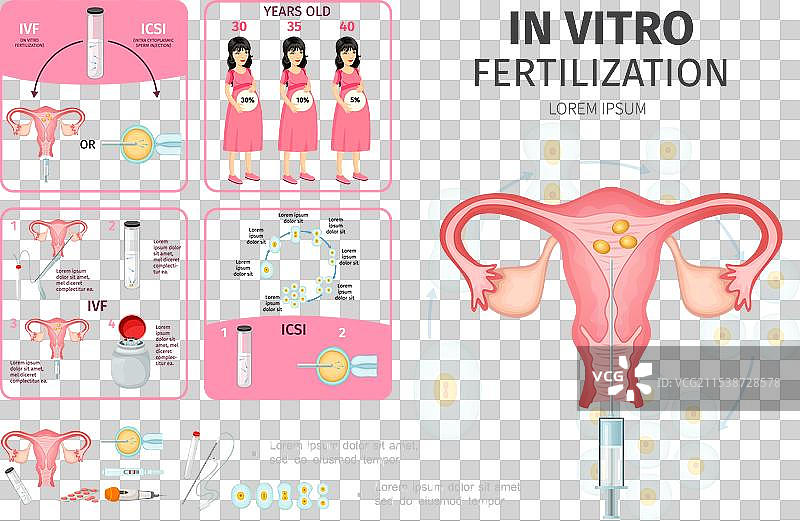 体外受精信息图概念图片素材