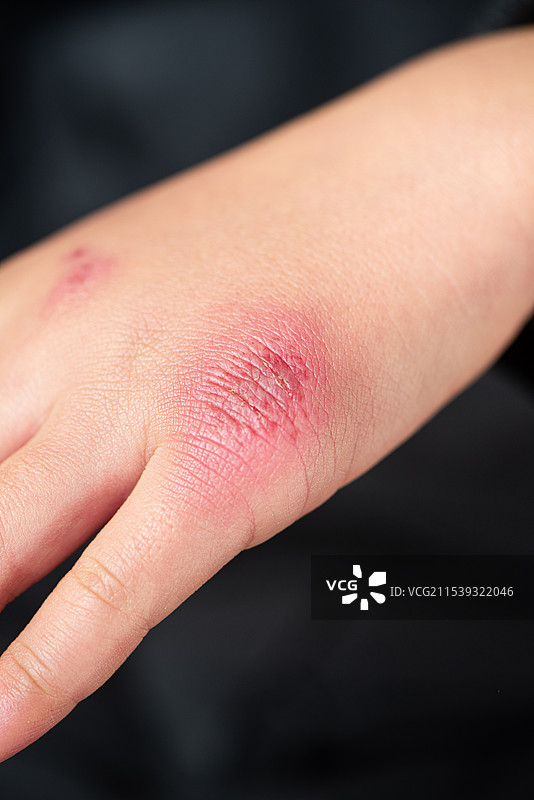 儿童手上的冻疮，冬天手冻伤图片素材