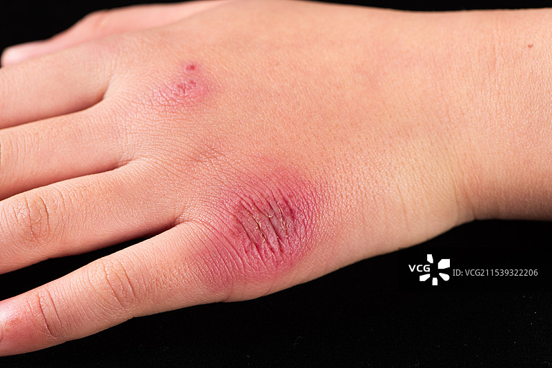 儿童手上的冻疮，冬天手冻伤图片素材