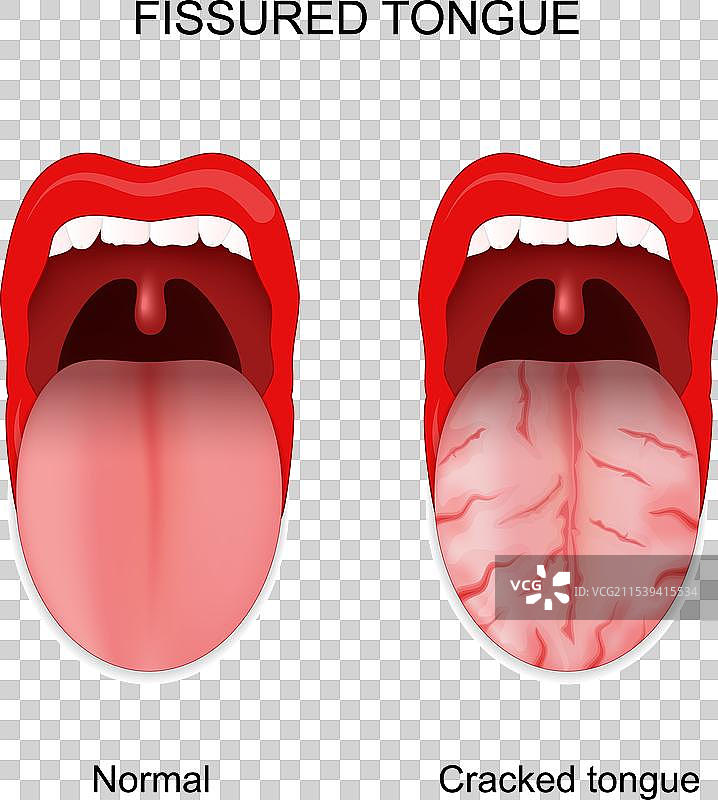 健康的裂纹舌与干裂的舌头图片素材