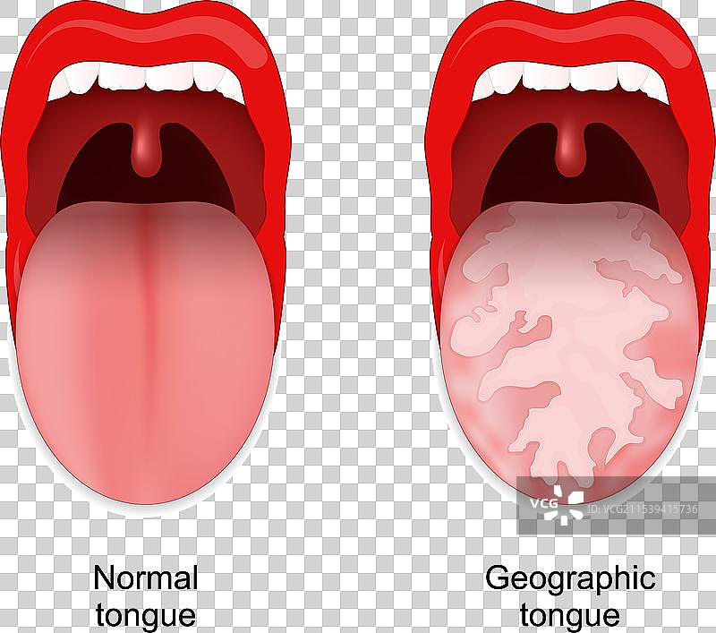 良性迁徙性舌炎图片素材