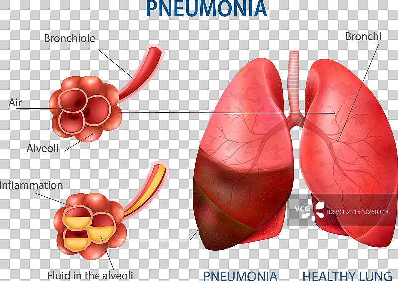 肺炎真实场景套件图片素材