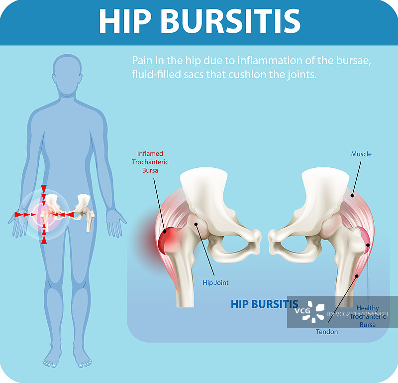 髋关节滑囊炎及受影响区域图片素材