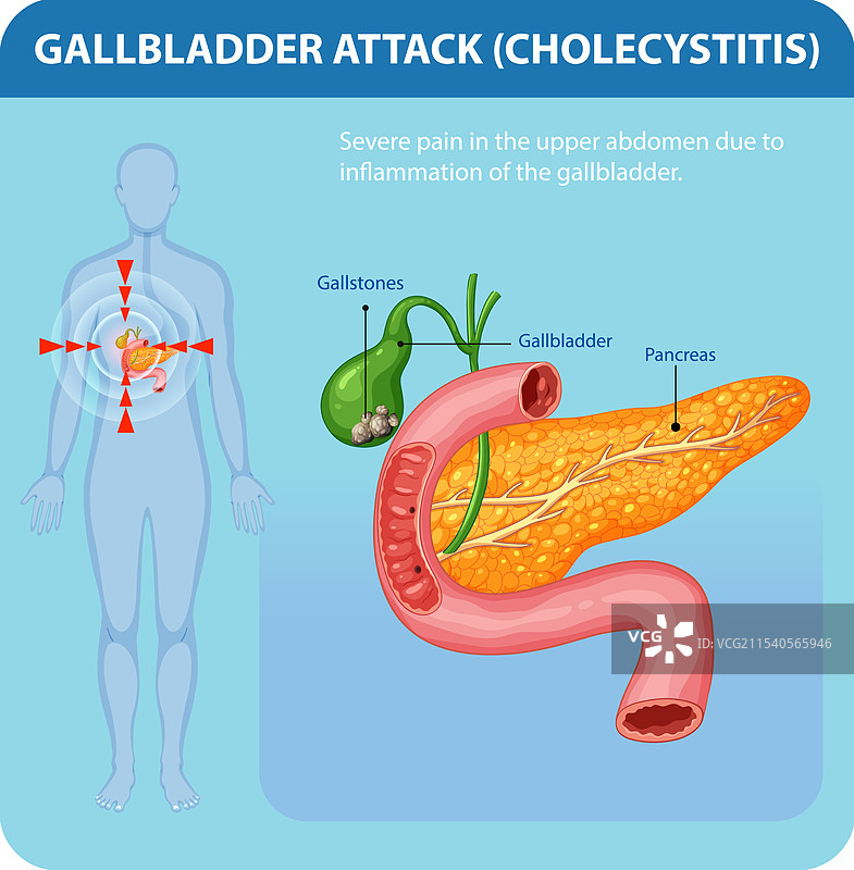 胆囊炎及相关疼痛图片素材
