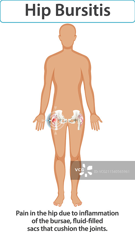 髋关节滑囊炎和关节炎图片素材