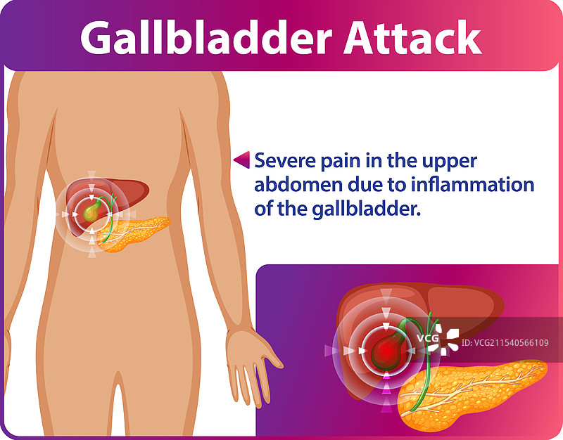 胆囊疼痛和炎症图片素材