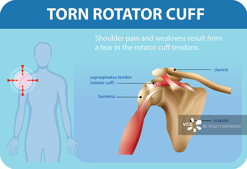 肩部解剖与损伤细节图片素材
