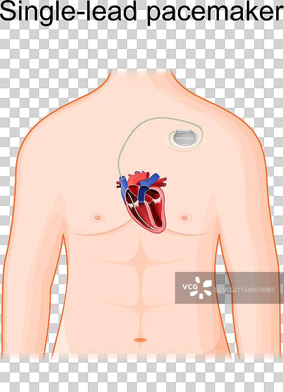 单导线起搏器植入的横截面图片素材