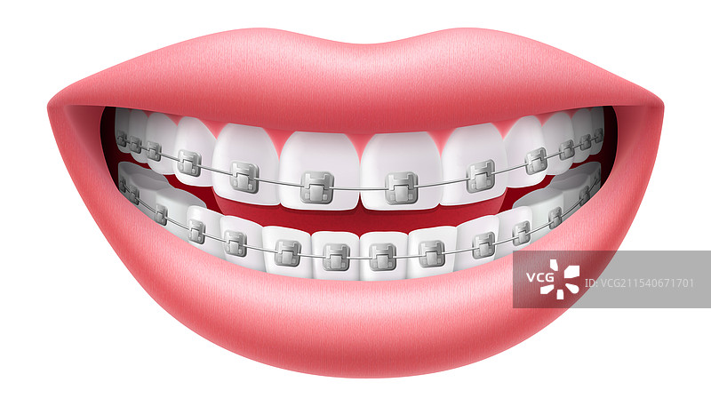 带牙套的洁白微笑，背景为纯色。图片素材