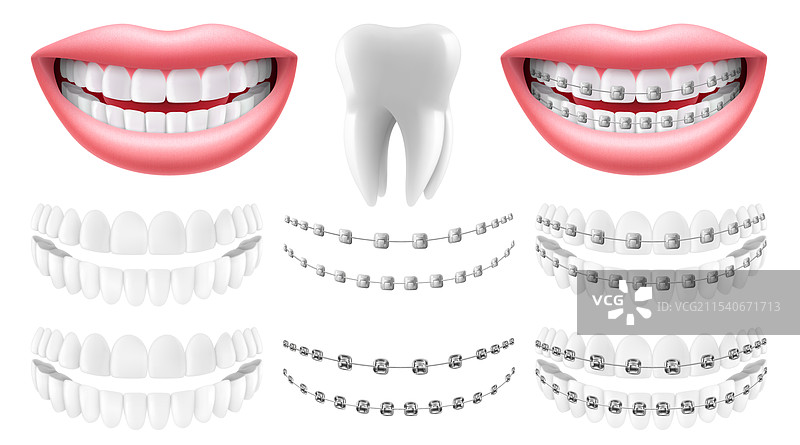 没有牙套的牙齿弓形牙套图片素材