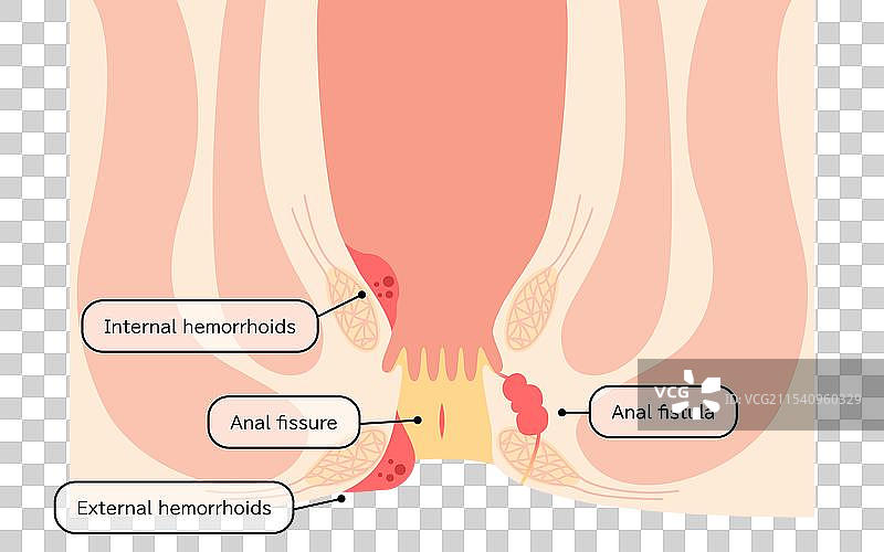 肛门疾病：痔疮、疣、切口图片素材
