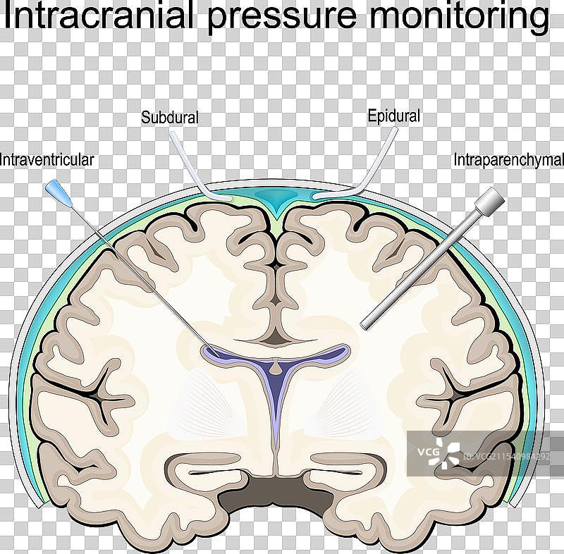 颅内压（ICP）监测图片素材