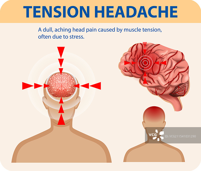 紧张性头痛与大脑解剖结构图片素材