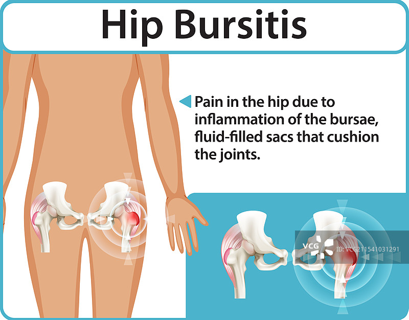 髋关节滑囊炎和关节炎图片素材