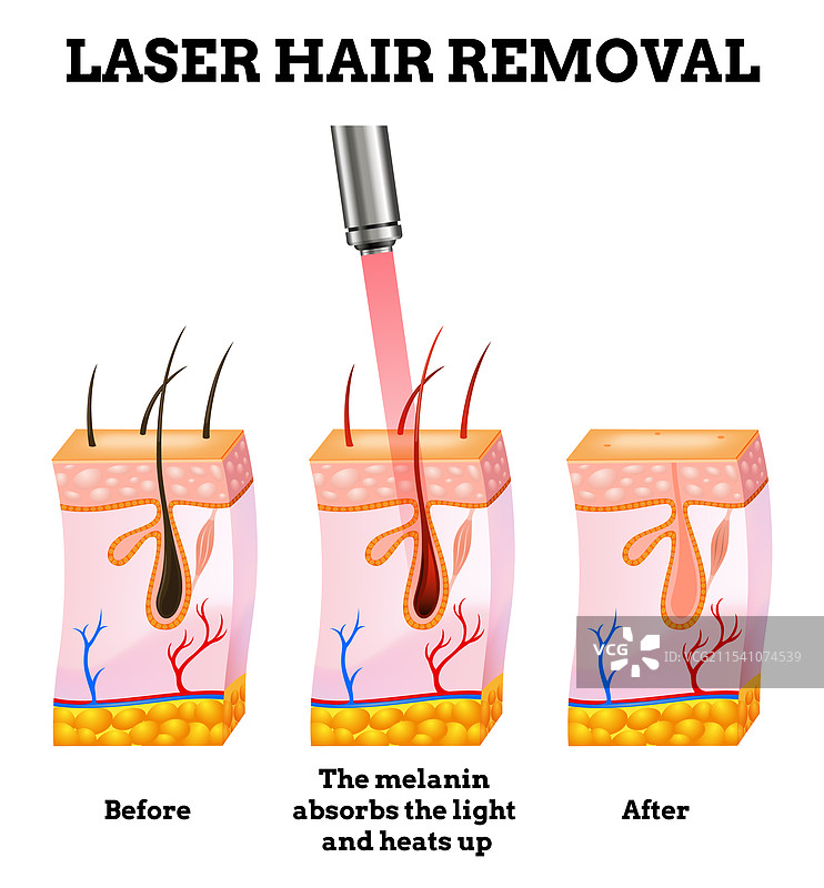 激光脱毛程序与浓缩剂图片素材