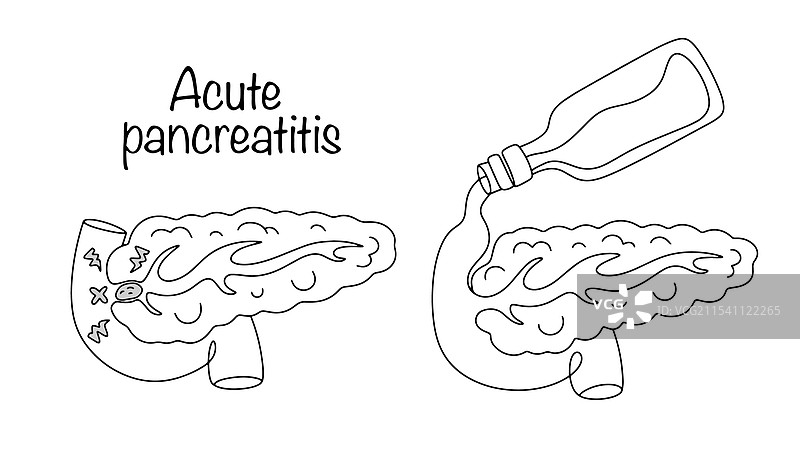 急性胰腺炎图片素材