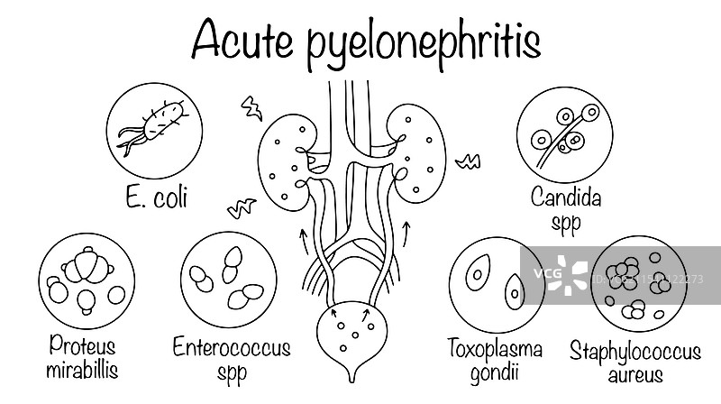 急性肾盂肾炎图片素材