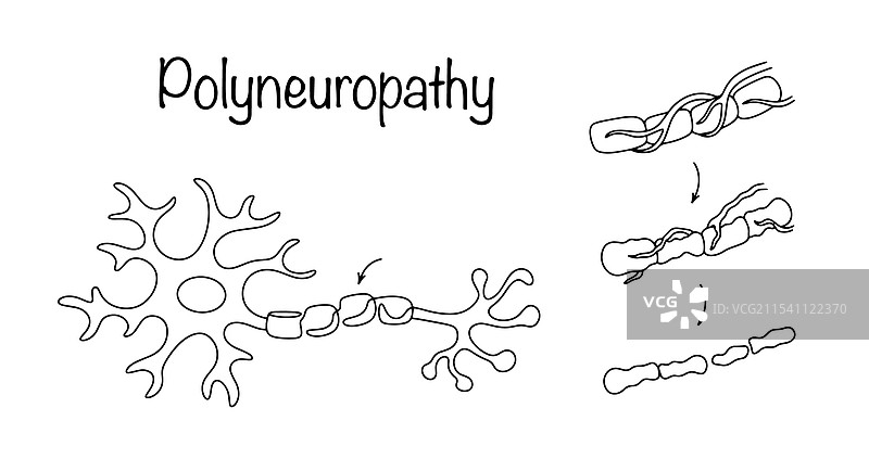 多发性神经病图片素材