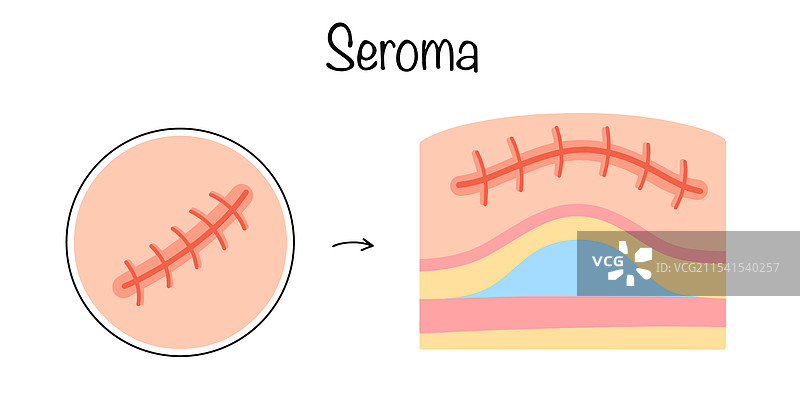 血清肿图片素材