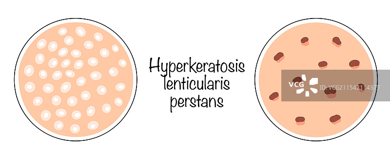 持续性透镜状角化症图片素材