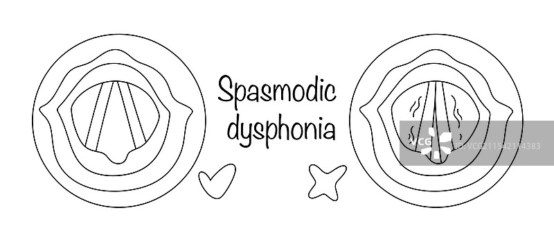痉挛性发声障碍图片素材