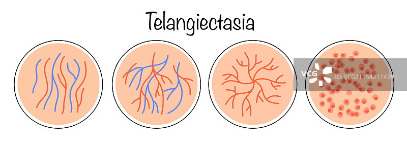 毛细血管扩张症图片素材