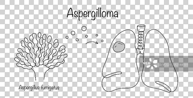 曲霉瘤图片素材