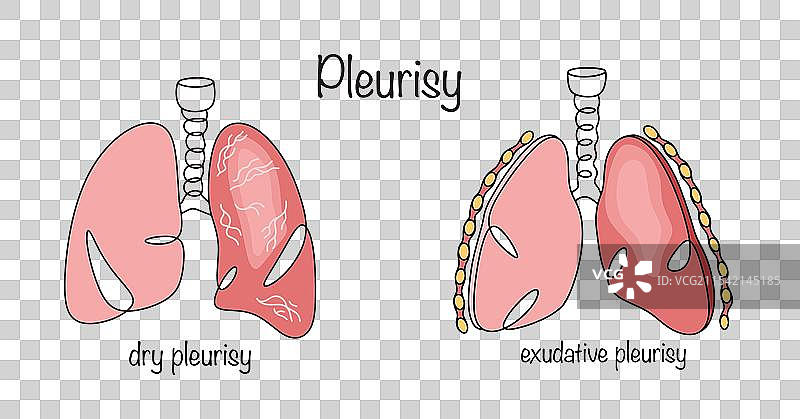 胸膜炎图片素材