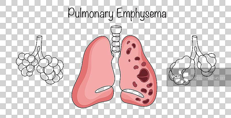 肺气肿图片素材