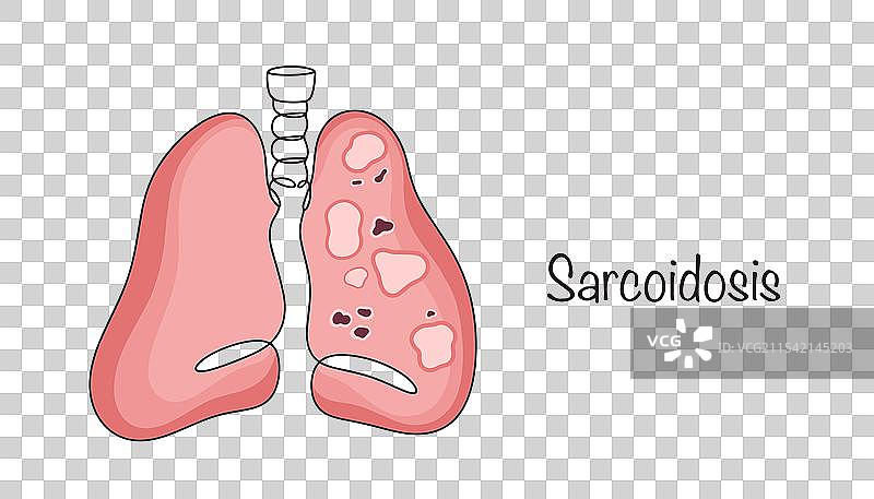 肉芽肿病图片素材