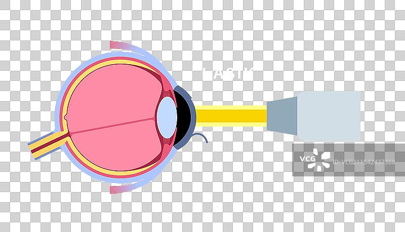 激光矫正视力手术图片素材