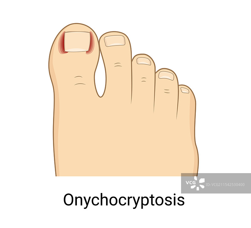 脚部甲沟炎图片素材