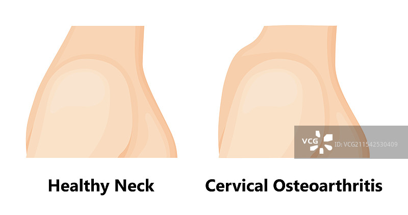 颈椎骨关节病与健康的颈部图片素材