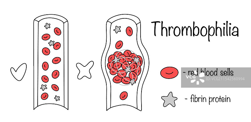血栓倾向图片素材