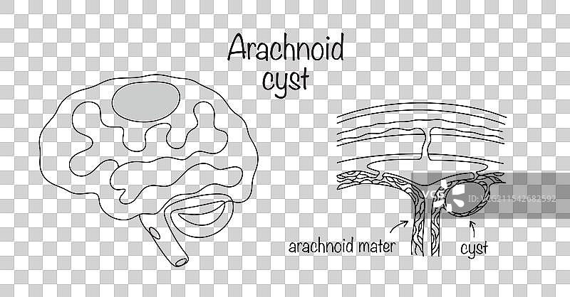 蛛网膜囊肿图片素材