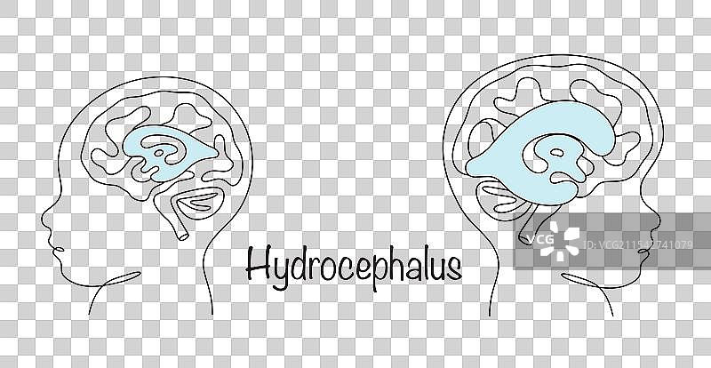 脑积水图片素材