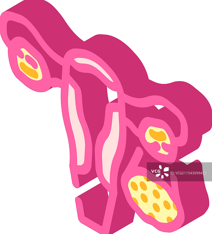 多囊卵巢综合症女性疾病等距图图片素材