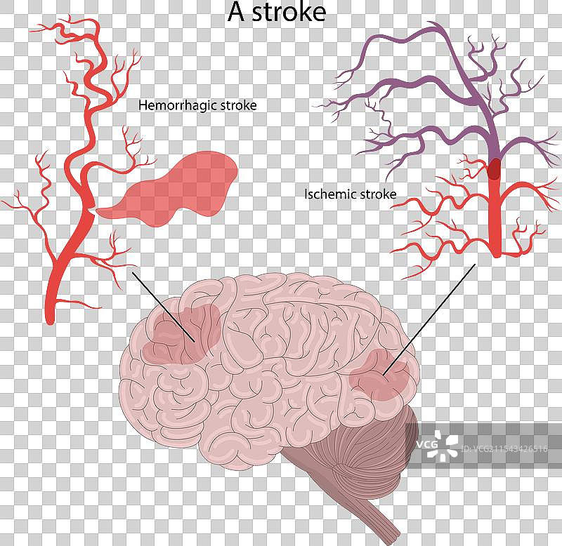 出血性中风和缺血性中风图片素材