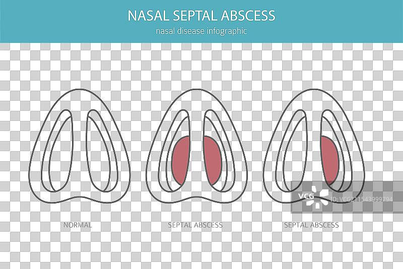 鼻中隔脓肿 鼻科疾病 医学图片素材