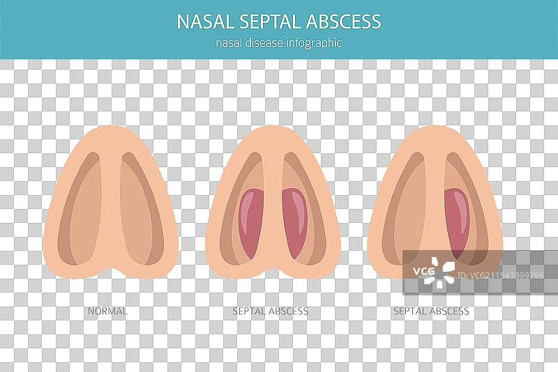 鼻中隔脓肿 鼻科疾病 医学图片素材
