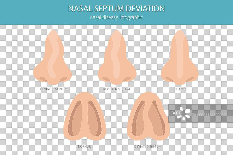 鼻中隔偏曲 鼻部疾病 医学图片素材