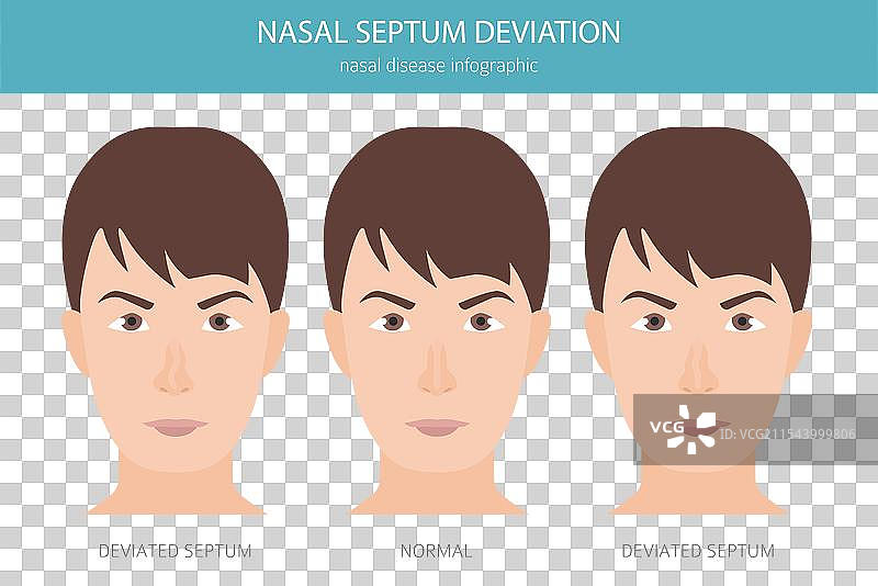 鼻中隔偏曲 鼻部疾病 医学图片素材