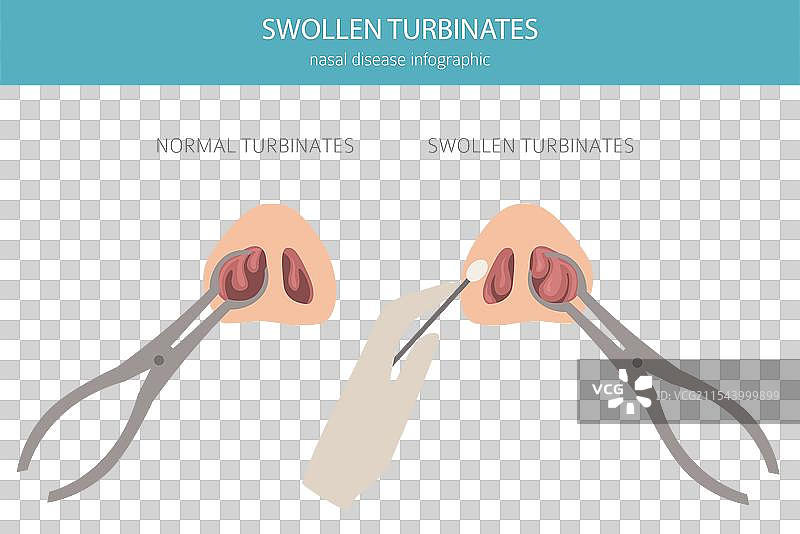 肿胀的鼻甲 鼻部疾病 医学图片素材